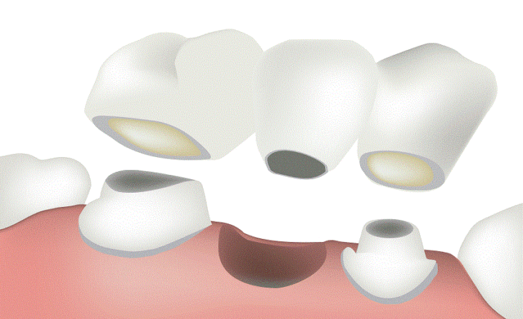 replace missing teeth options