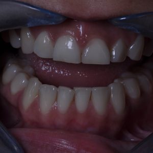 bruxism and teeth grinding